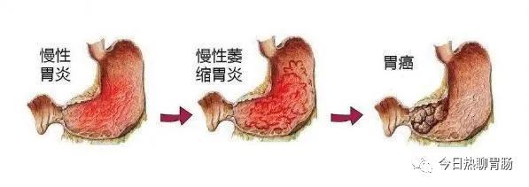胃全切除后怎样预防癌细胞转移